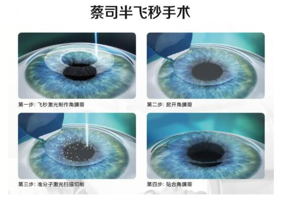 準(zhǔn)分子激光手術(shù)到底是怎么治 愈你的眼睛的？