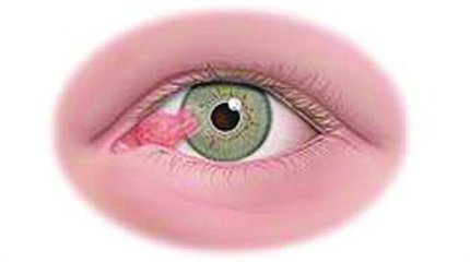 眼睛上會(huì)有一塊肉，影響視力怎么辦？