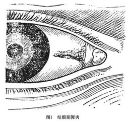 黑眼睛前面多長出一塊白肉怎么辦？