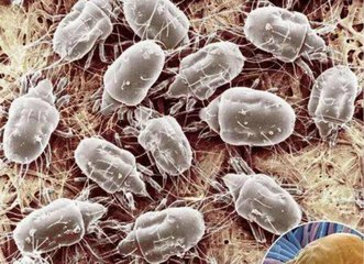 個人衛(wèi)生差，螨蟲會寄宿眼部得蠕形螨瞼緣炎