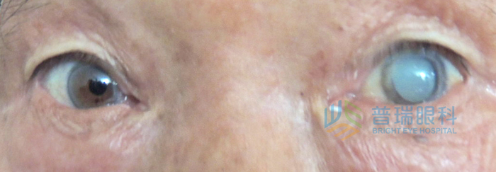 醫(yī)學(xué)小知識(shí):有哪些因素可造成白內(nèi)障眼病