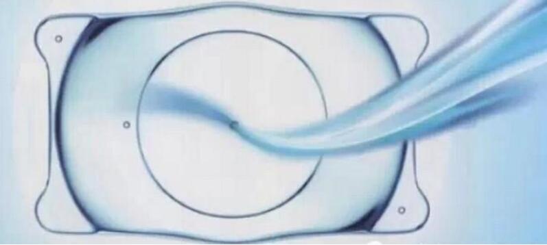 為什么ICL晶體近視眼手術(shù)時(shí)間會很長？