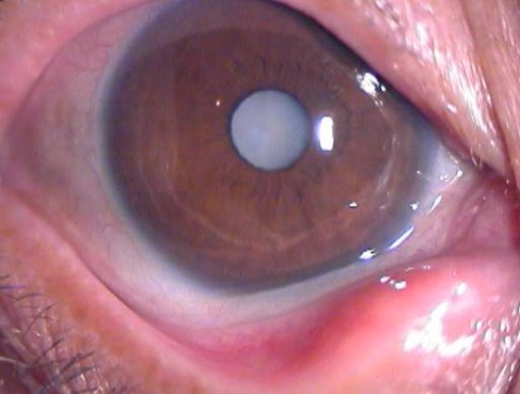 眼科醫(yī)生教你:如何預(yù)防白內(nèi)障?