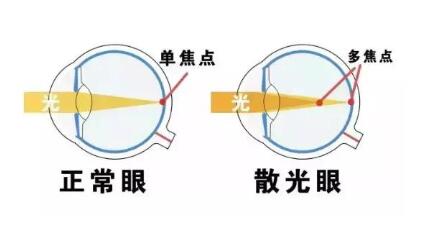 近視和散光，手術(shù)能同時(shí)矯正嗎？