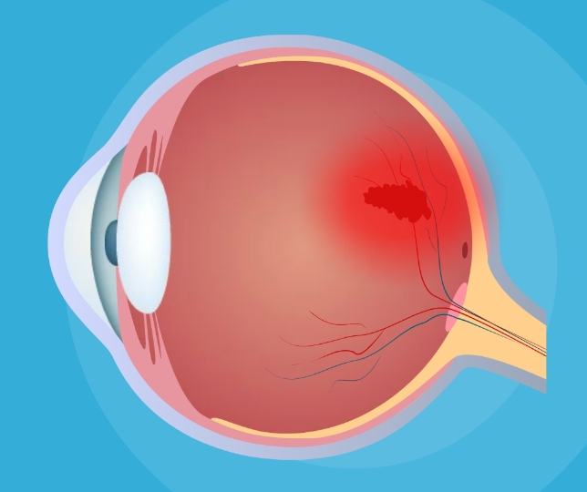 科普:眼底出血