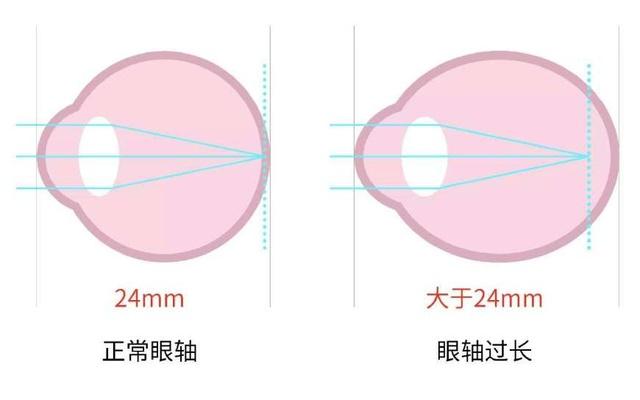 眼科醫(yī)生解密:哪些行為近視度數(shù)增長快