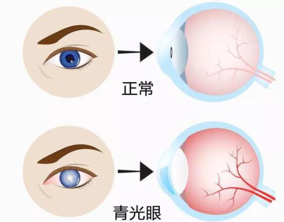 第17個青光眼周｜共管慢病青光眼，留得光明恒久遠